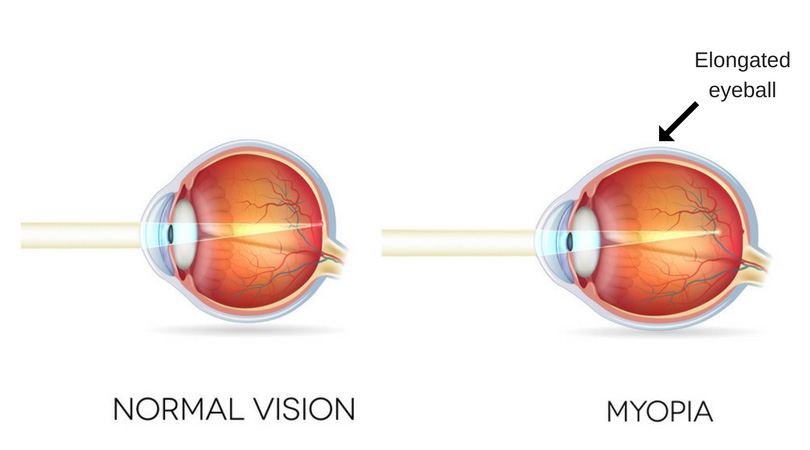 Normal eye versus myopic eye